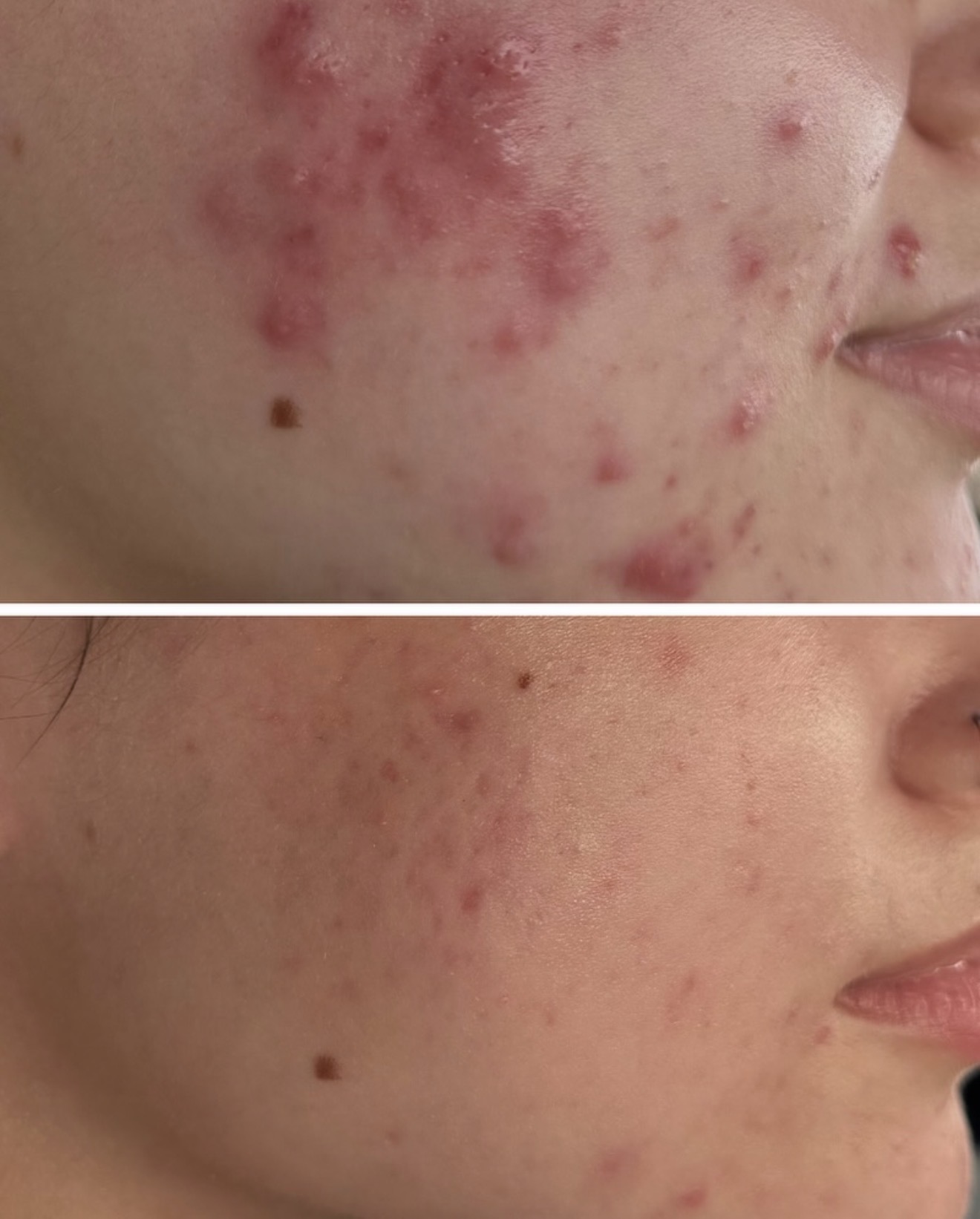 Acne Clearing Before and After